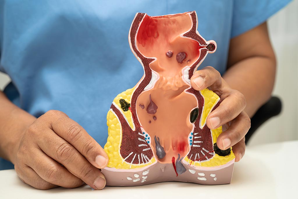 rectum and hemorrhoid human anat