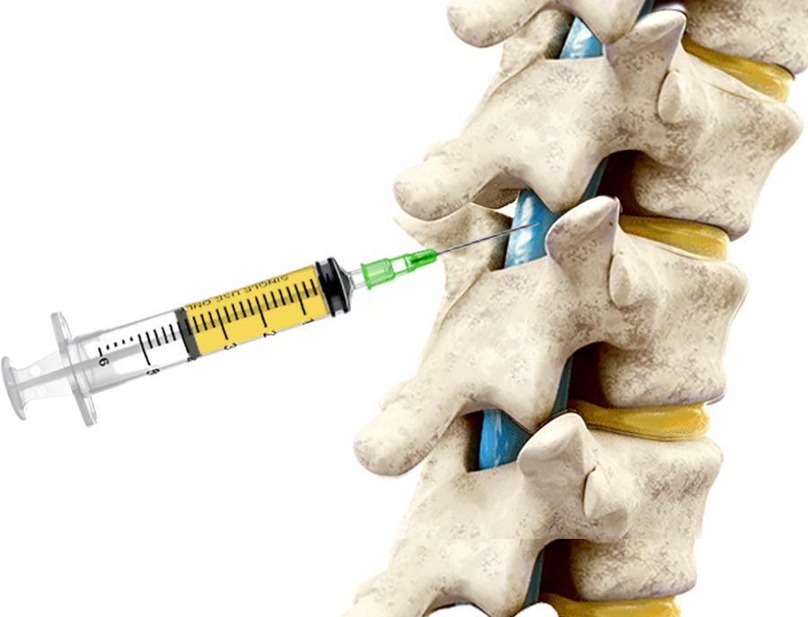 spine injection orange county ca 1